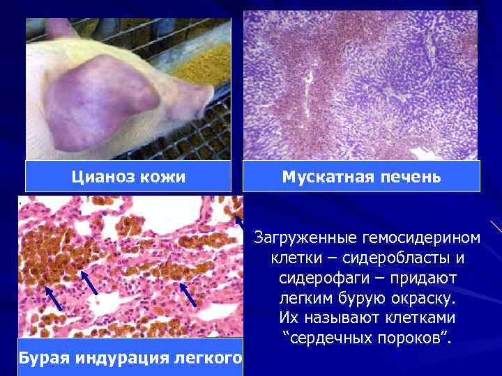 Цианоз кожи Мускатная печень Загруженные гемосидерином клетки – сидеробласты и сидерофаги – придают легким