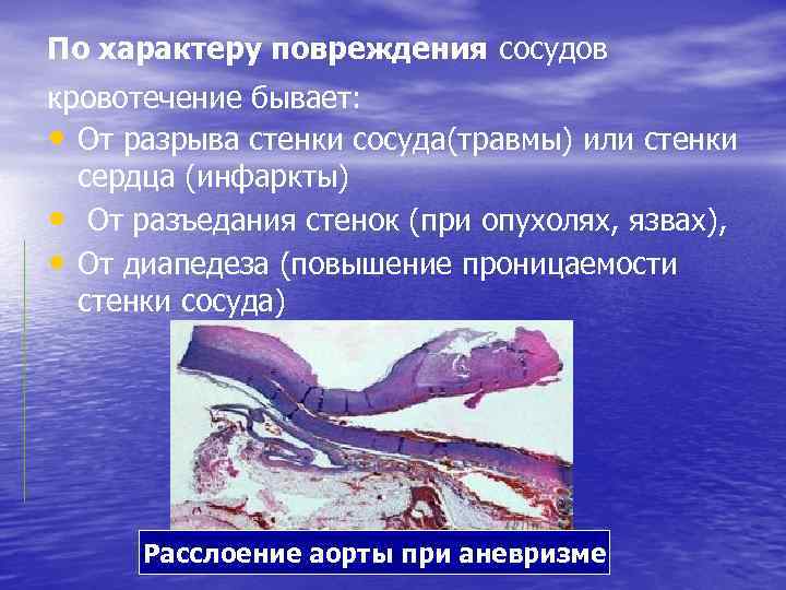 По характеру повреждения сосудов кровотечение бывает: • От разрыва стенки сосуда(травмы) или стенки сердца