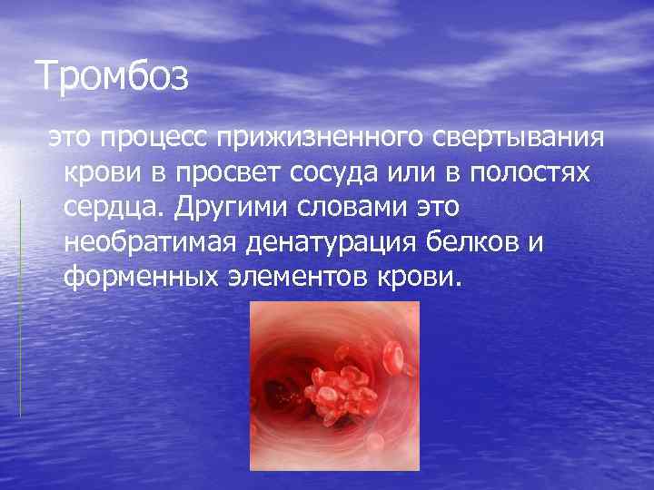 Тромбоз это процесс прижизненного свертывания крови в просвет сосуда или в полостях сердца. Другими