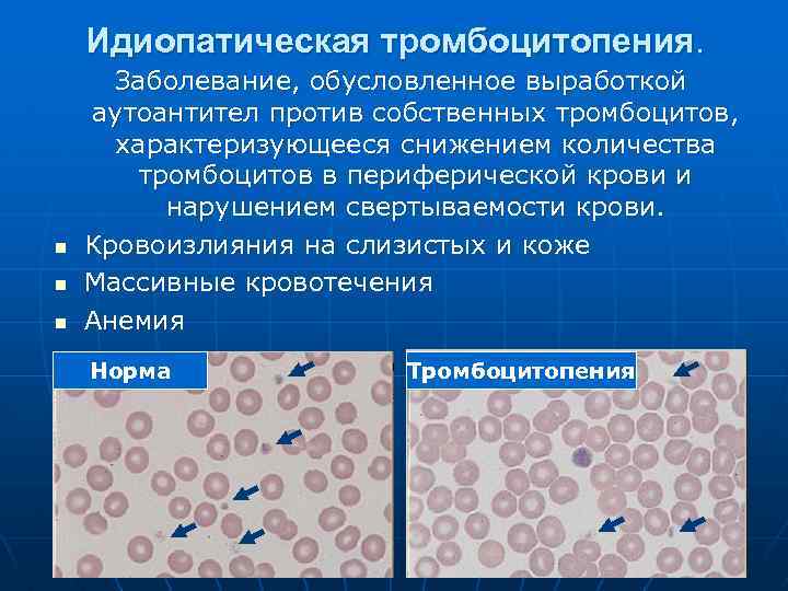 Тромбоцитопения в анализе крови