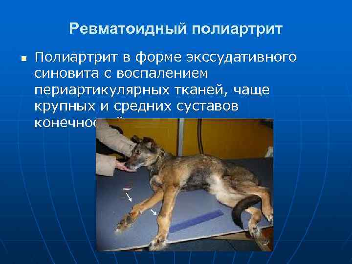 Ревматоидный полиартрит n Полиартрит в форме экссудативного синовита с воспалением периартикулярных тканей, чаще крупных