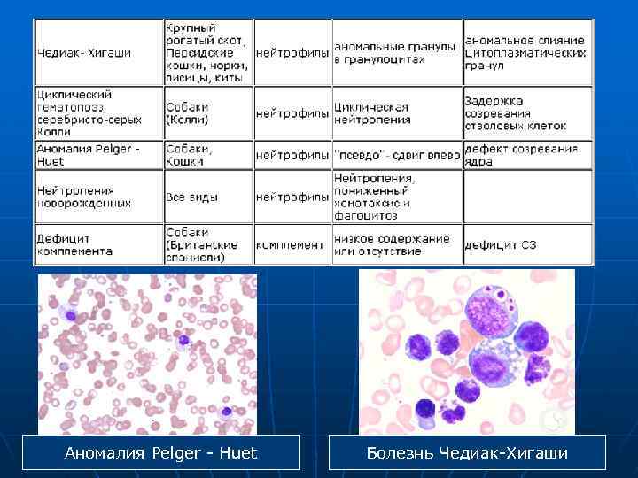 Аномалия Pelger - Huet Болезнь Чедиак-Хигаши 