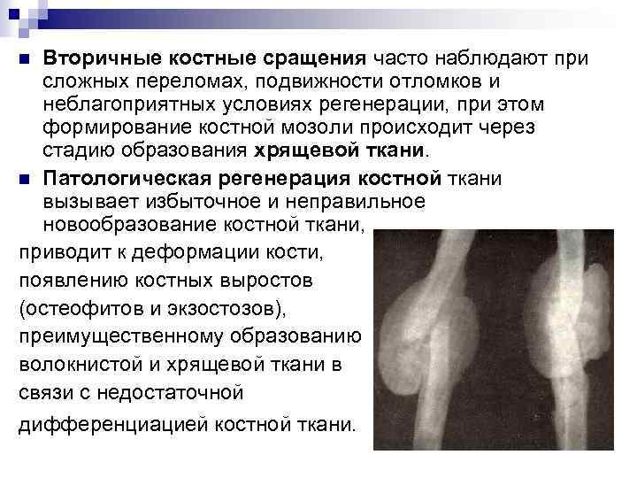 Вторичные костные сращения часто наблюдают при сложных переломах, подвижности отломков и неблагоприятных условиях регенерации,