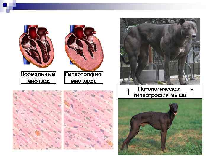 Нормальный миокард Гипертрофия миокарда Патологическая гипертрофия мышц 