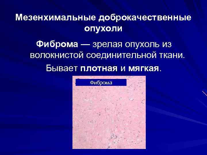 Мезенхимальные доброкачественные опухоли Фиброма — зрелая опухоль из волокнистой соединительной ткани. Бывает плотная и