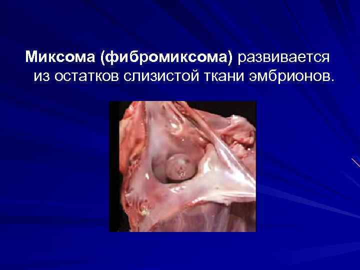 Миксома (фибромиксома) развивается из остатков слизистой ткани эмбрионов. 