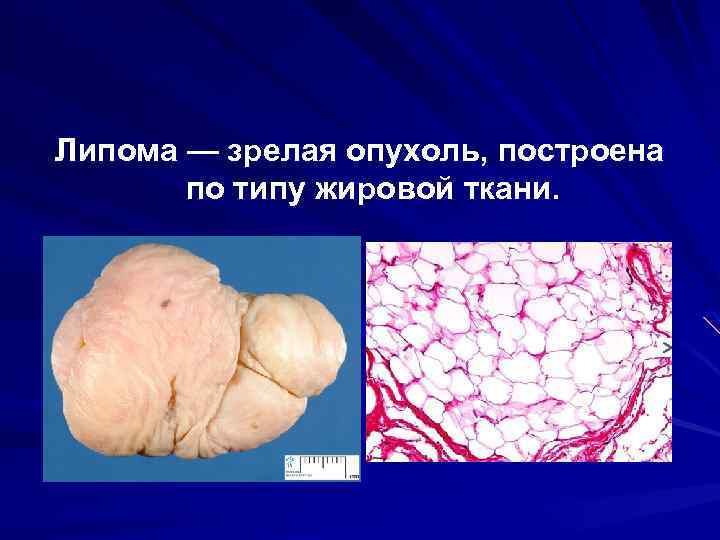 Липома — зрелая опухоль, построена по типу жировой ткани. 
