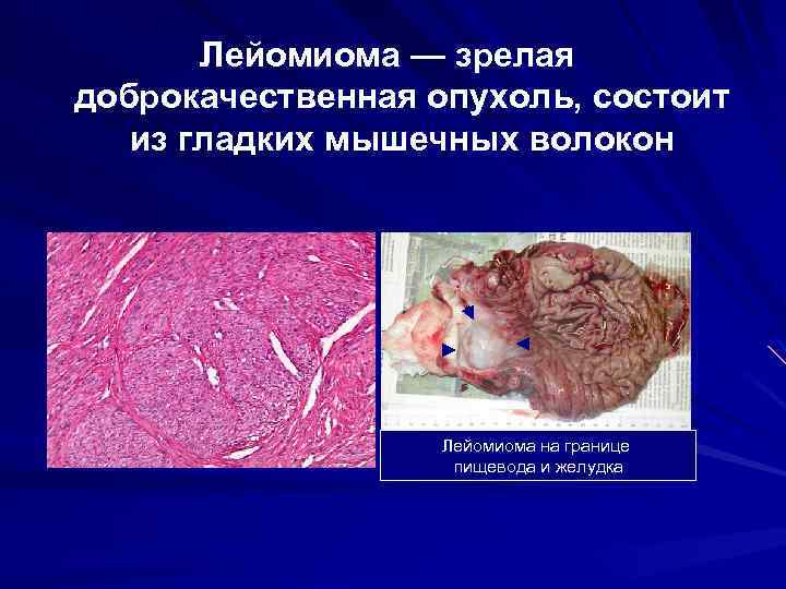 Лейомиома — зрелая доброкачественная опухоль, состоит из гладких мышечных волокон Лейомиома на границе пищевода