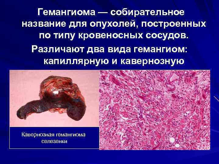 Гемангиома — собирательное название для опухолей, построенных по типу кровеносных сосудов. Различают два вида