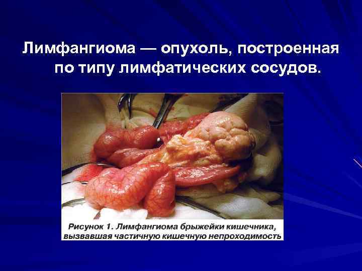 Лимфангиома — опухоль, построенная по типу лимфатических сосудов. 