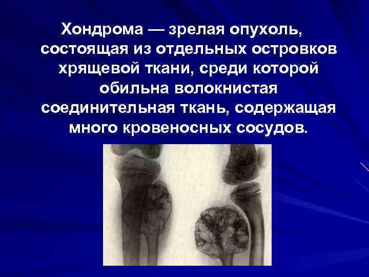 Хондрома — зрелая опухоль, состоящая из отдельных островков хрящевой ткани, среди которой обильна волокнистая