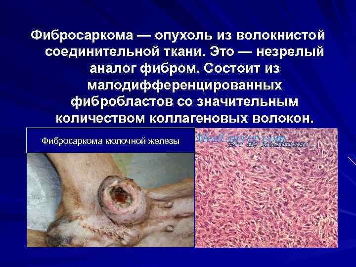 Фибросаркома — опухоль из волокнистой соединительной ткани. Это — незрелый аналог фибром. Состоит из