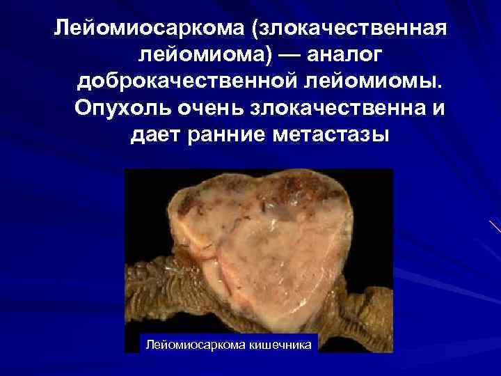 Лейомиосаркома (злокачественная лейомиома) — аналог доброкачественной лейомиомы. Опухоль очень злокачественна и дает ранние метастазы