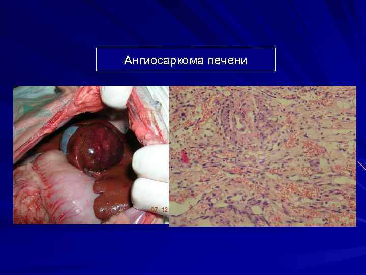 Ангиосаркома печени 