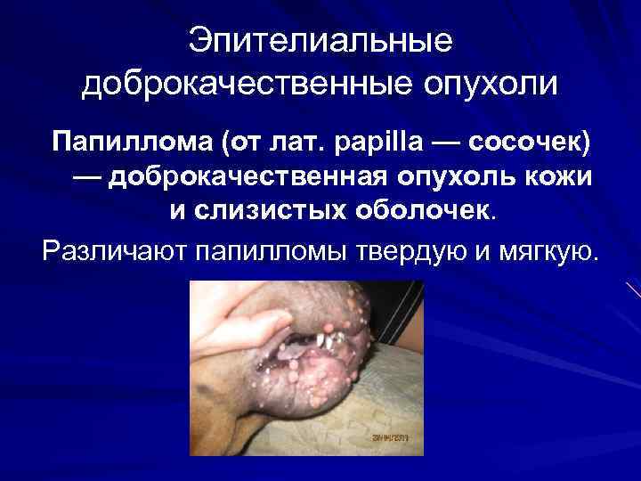 Эпителиальные доброкачественные опухоли Папиллома (от лат. papilla — сосочек) — доброкачественная опухоль кожи и