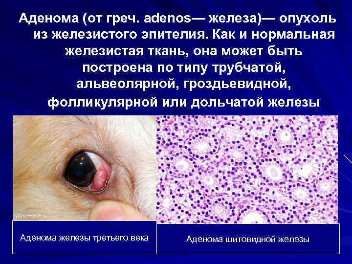 Аденома (от греч. adenos— железа)— опухоль из железистого эпителия. Как и нормальная железистая ткань,