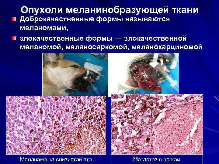 Опухоли меланинобразующей ткани Доброкачественные формы называются меланомами, злокачественные формы — злокачественной меланомой, меланосаркомой, меланокарциномой.