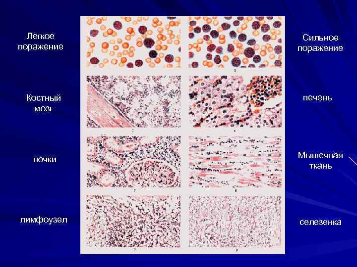 Легкое поражение Костный мозг Сильное поражение печень почки Мышечная ткань лимфоузел селезенка 