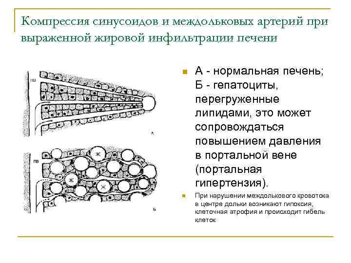Компрессия синусоидов и междольковых артерий при выраженной жировой инфильтрации печени n n А -