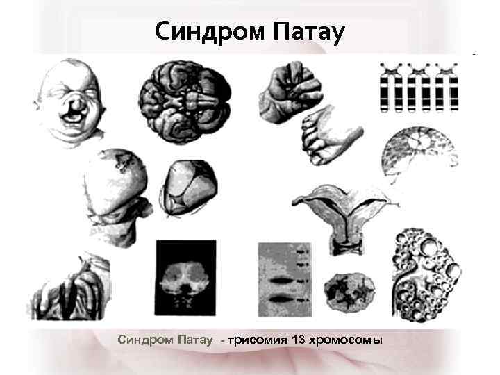 Синдром Патау - трисомия 13 хромосомы 