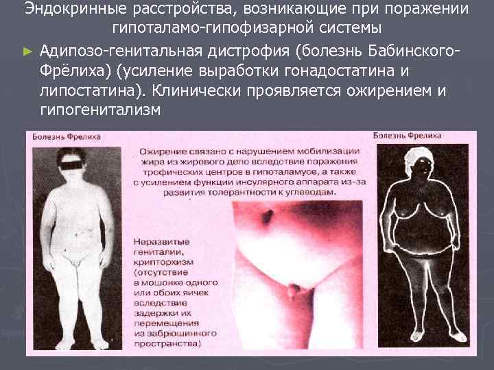Эндокринные расстройства, возникающие при поражении гипоталамо-гипофизарной системы ► Адипозо-генитальная дистрофия (болезнь Бабинского. Фрёлиха) (усиление