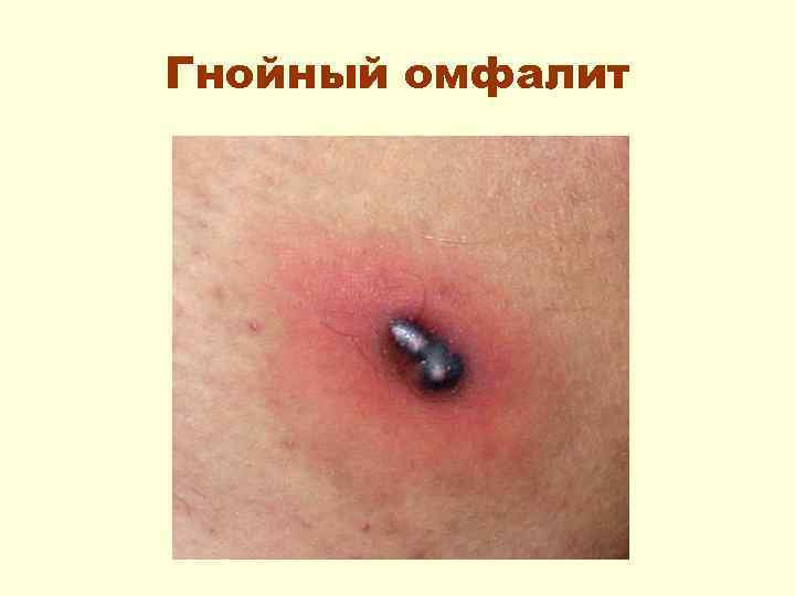 Гнойный омфалит 