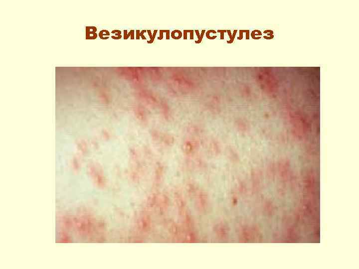Везикулопустулез 