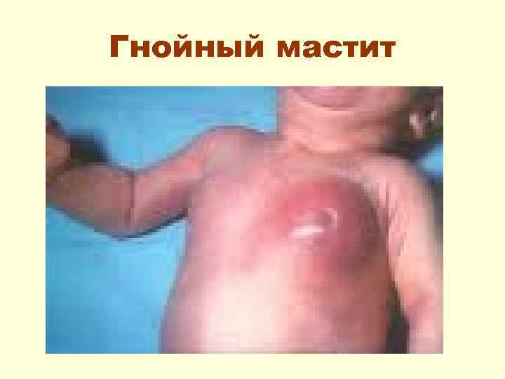 Гнойный мастит 