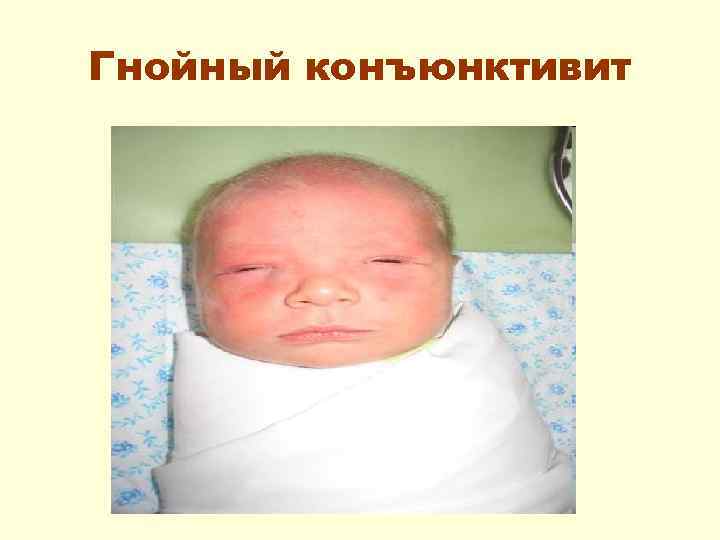 Гнойный конъюнктивит 