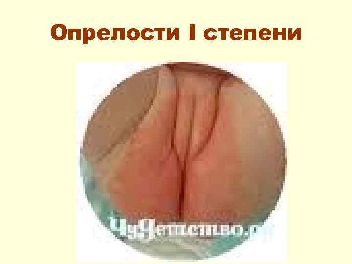 Опрелости I степени 