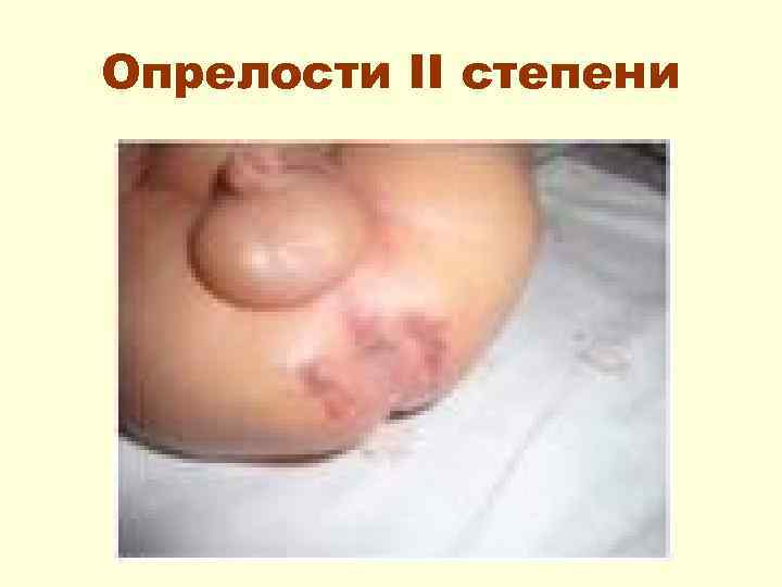 Опрелости II степени 