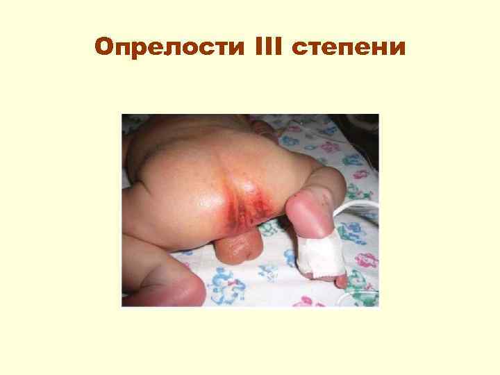 Опрелости III степени 