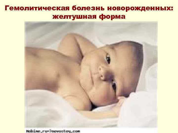 Гемолитическая болезнь новорожденных: желтушная форма 