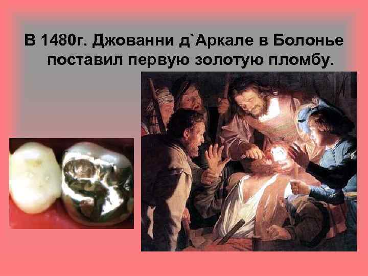 В 1480 г. Джованни д`Аркале в Болонье поставил первую золотую пломбу. 