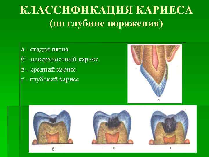 КЛАССИФИКАЦИЯ КАРИЕСА (по глубине поражения) a - стадия пятна б - поверхностный кариес в