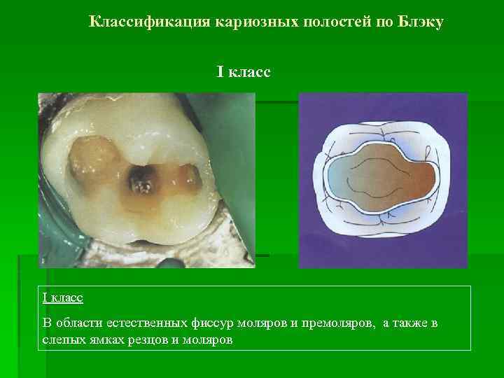 Классификация кариозных полостей по Блэку I класс В области естественных фиссур моляров и премоляров,