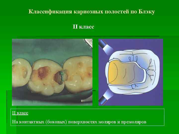 Классификация кариозных полостей по Блэку II класс На контактных (боковых) поверхностях моляров и премоляров