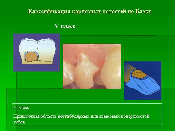 Классификация кариозных полостей по Блэку V класс Пришеечная область вестибулярных или языковых поверхностей зубов