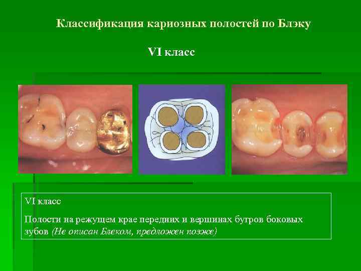 Классификация кариозных полостей по Блэку VI класс Полости на режущем крае передних и вершинах