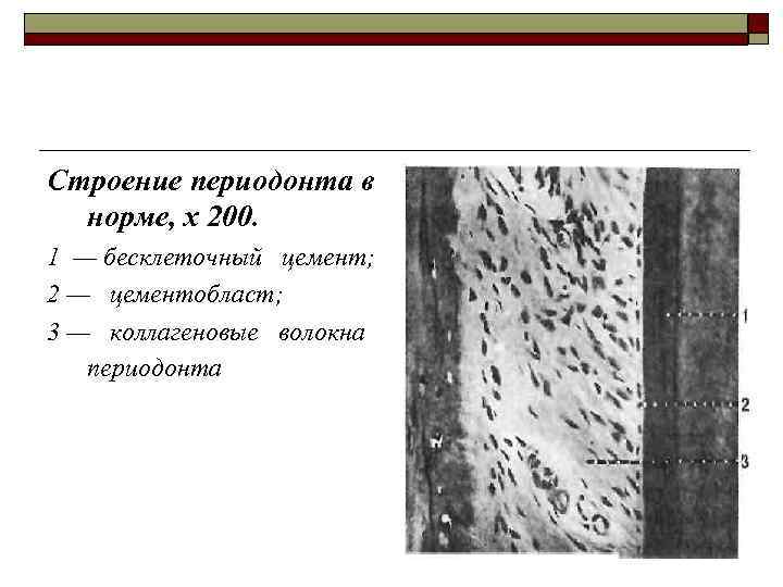 Строение периодонта в норме, х 200. 1 — бесклеточный цемент; 2 — цементобласт; 3