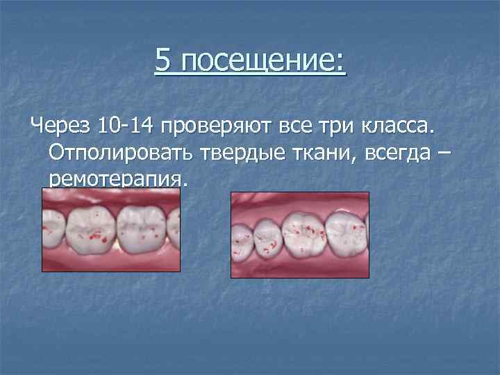 5 посещение: Через 10 -14 проверяют все три класса. Отполировать твердые ткани, всегда –