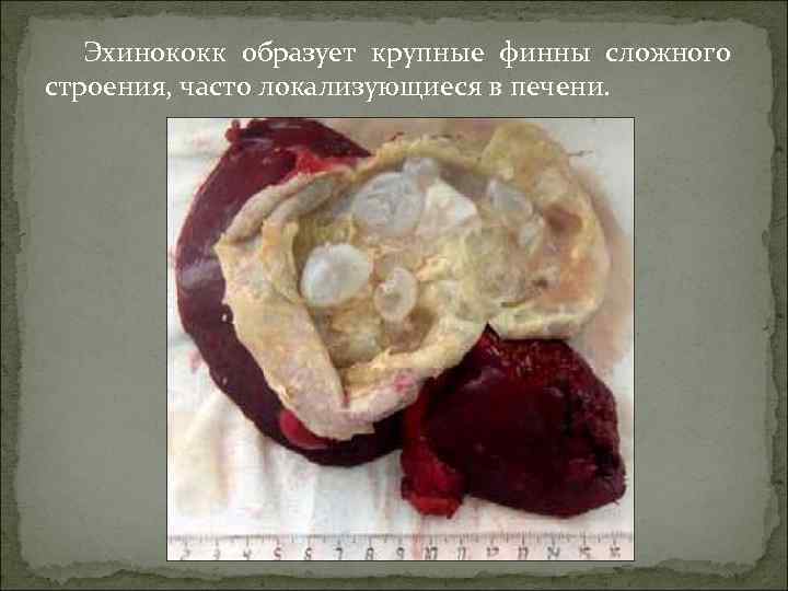 Эхинококк образует крупные финны сложного строения, часто локализующиеся в печени. 
