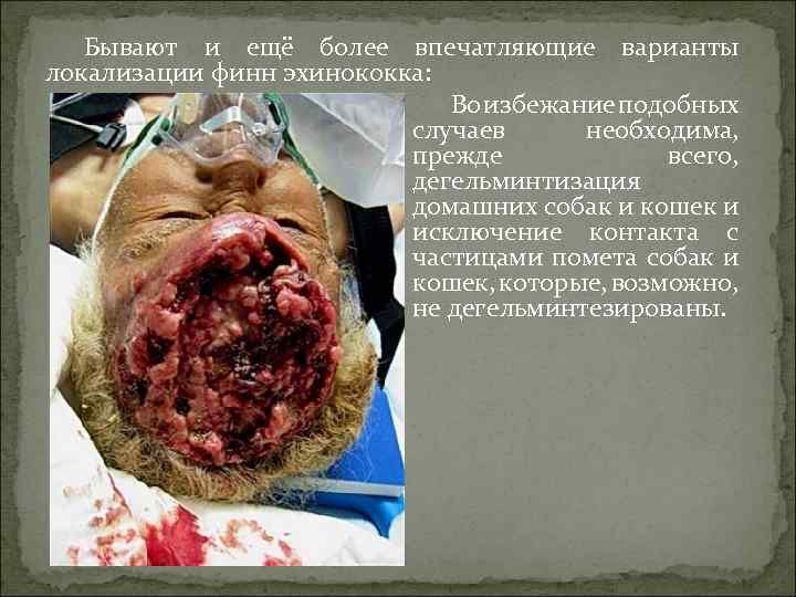 Бывают и ещё более впечатляющие варианты локализации финн эхинококка: Во избежание подобных случаев необходима,