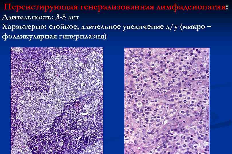 Реактивная гиперплазия лимфоузла. Фолликулярная гиперплазия. Персистирующая лимфаденопатия. Персистирующая генерализованная лимфаденопатия. Фолликулярная гиперплазия лимфатического узла.