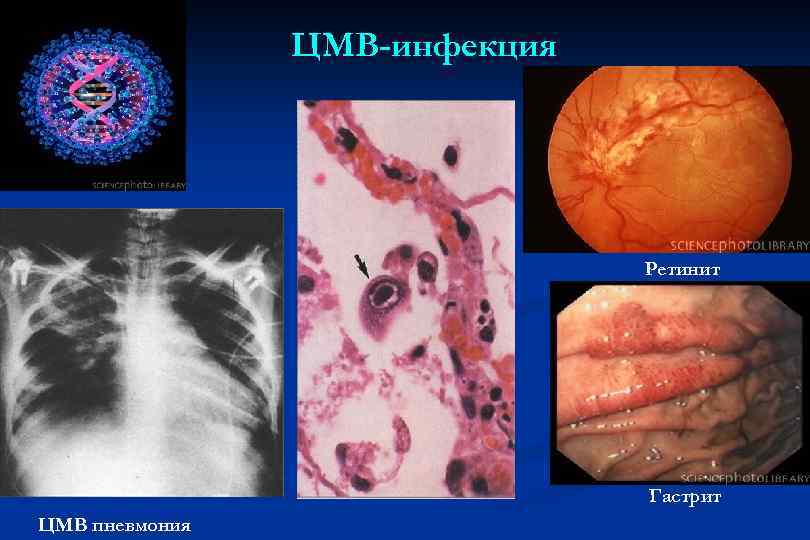 ЦМВ-инфекция Ретинит Гастрит ЦМВ пневмония 