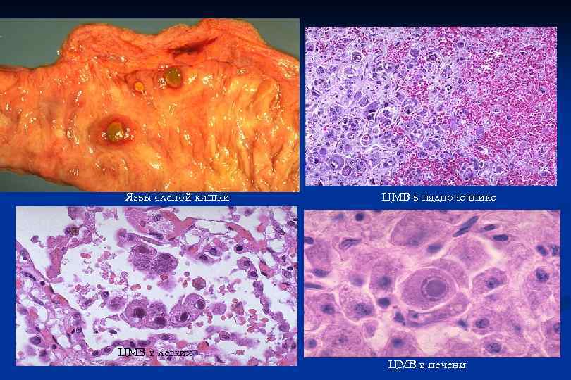 Язвы слепой кишки ЦМВ в легких ЦМВ в надпочечнике ЦМВ в печени 