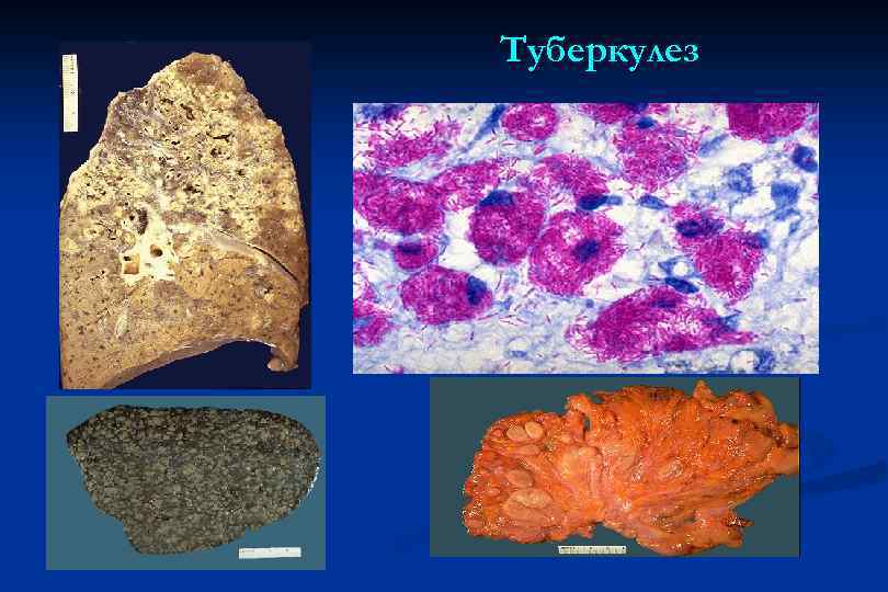 Туберкулез 