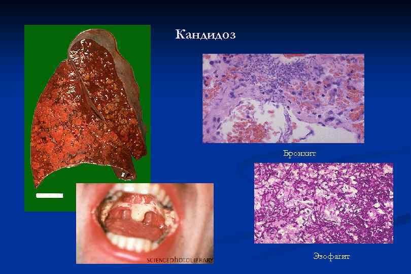Кандидоз Бронхит Эзофагит 