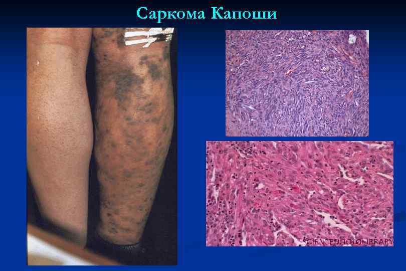 Саркома Капоши 