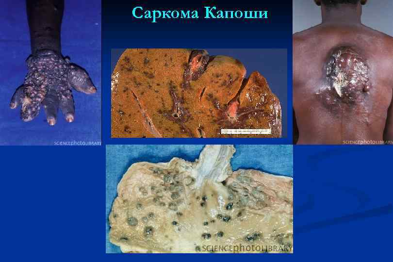 Саркома Капоши 